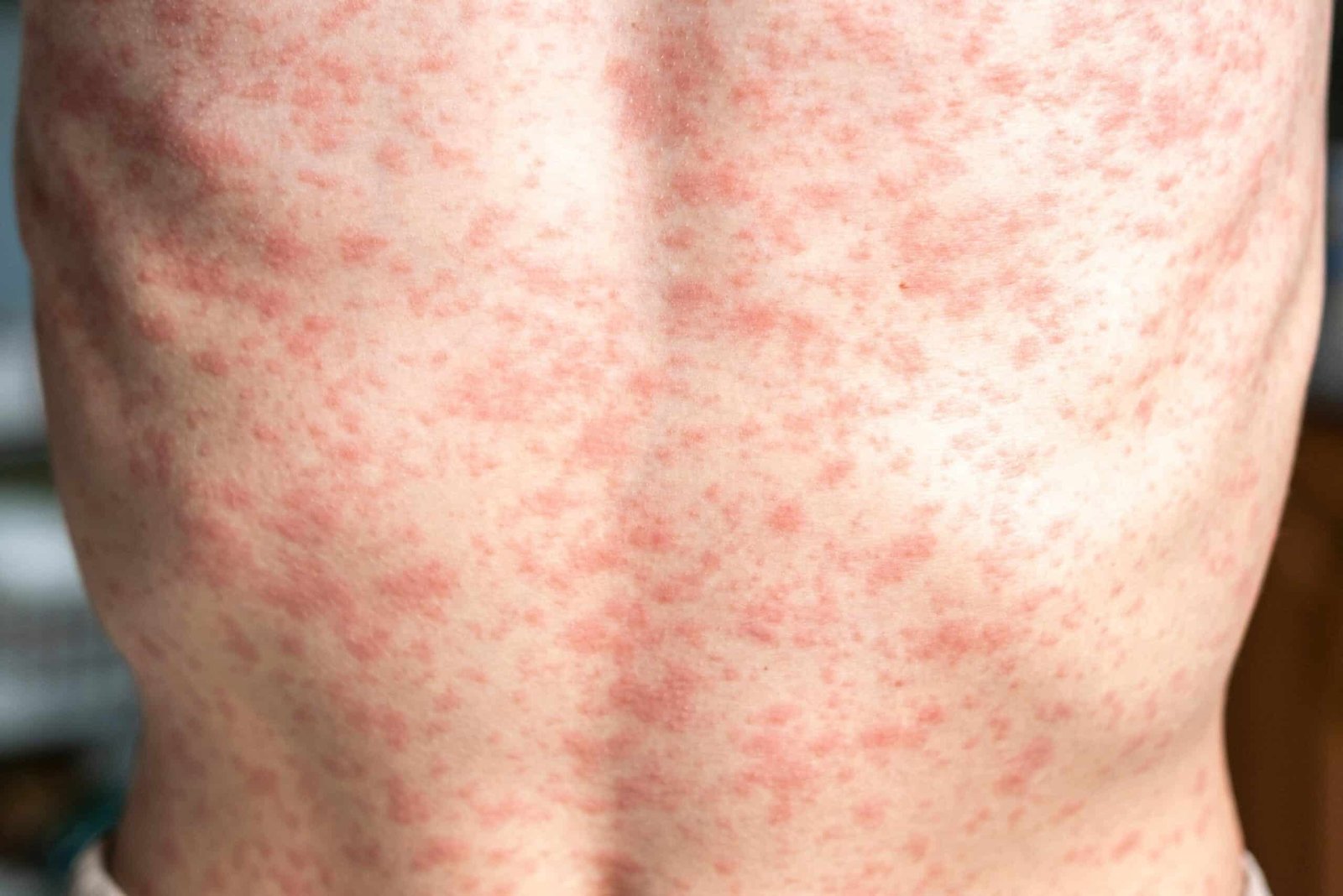 The death of the unconacted child's measles is the first fatality in the outbreak of western Texas